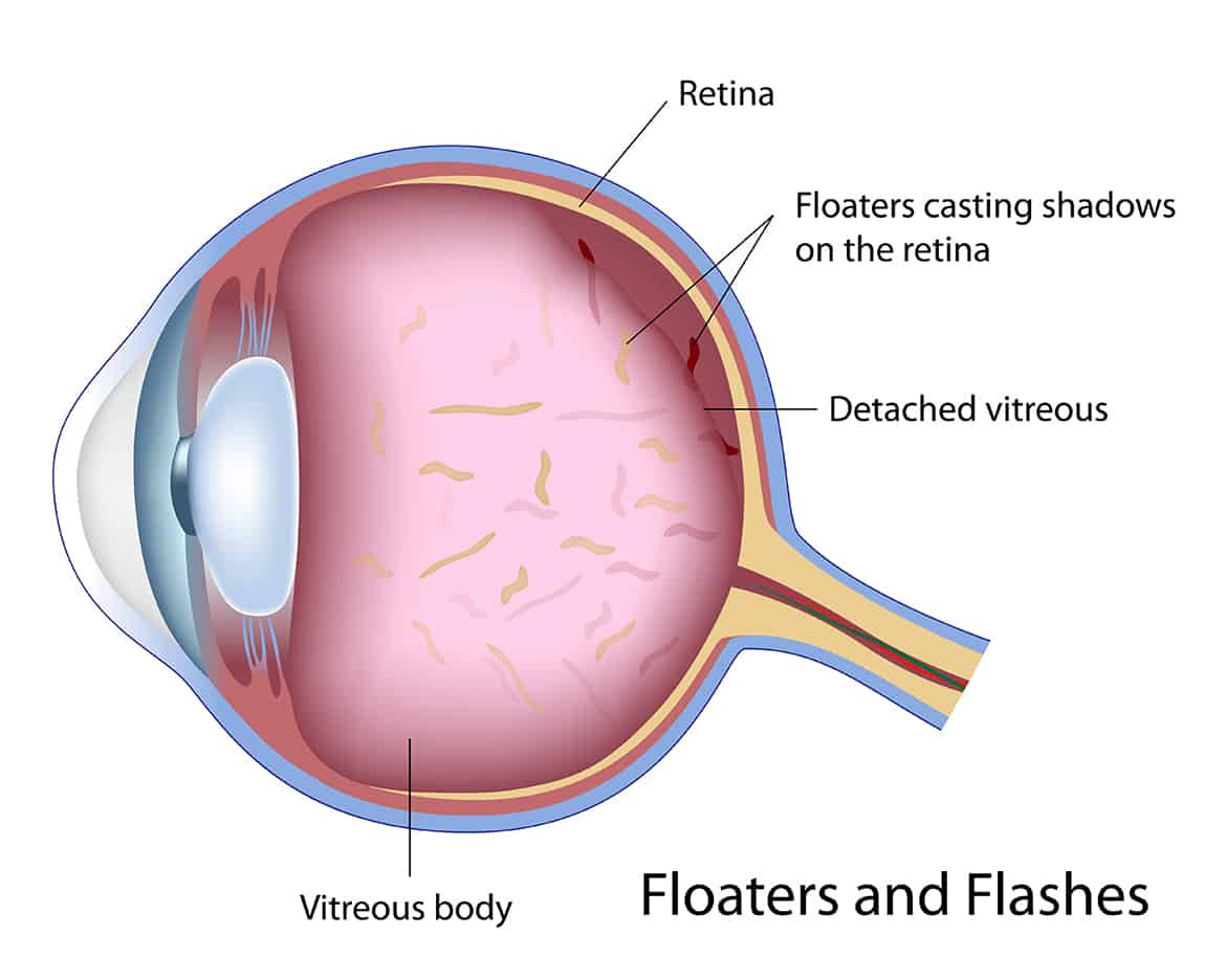 How to reduce eye floaters